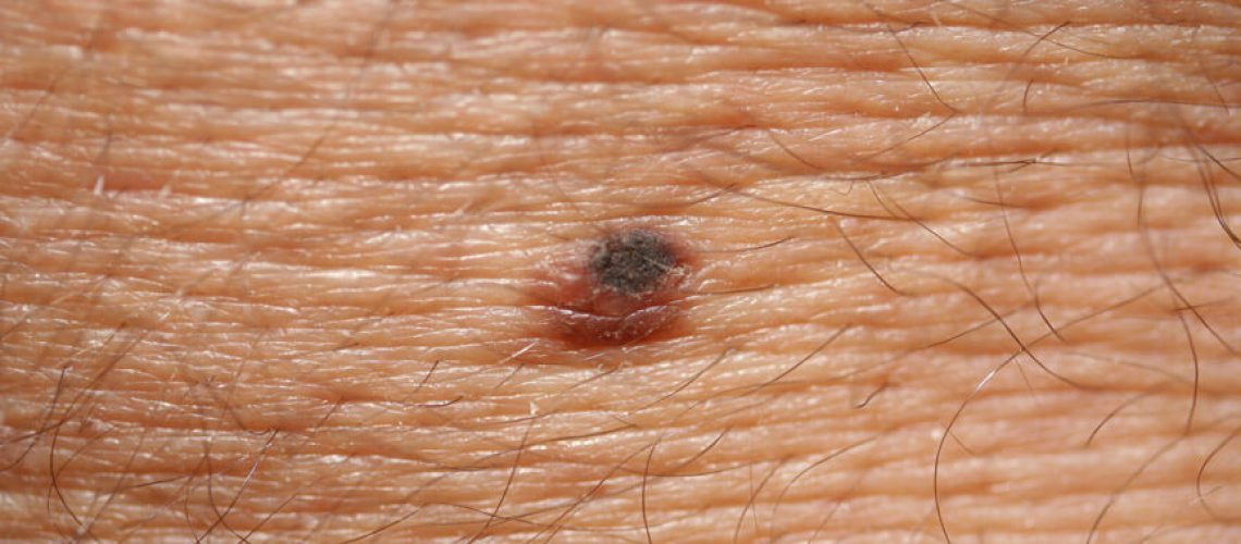 Føflekker og malignt melanom1