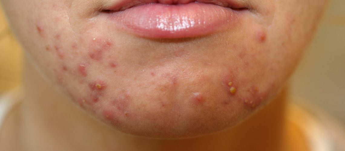Kviser (acne)